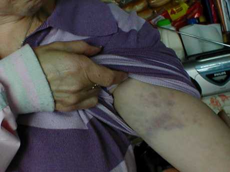 Mary's injuries after being hauled from the trailer this week
