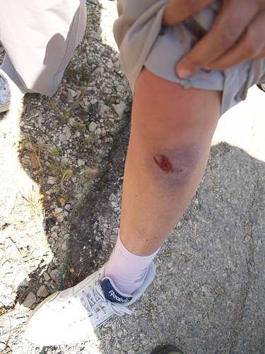 Rubber-coated steel bullet wound to the leg